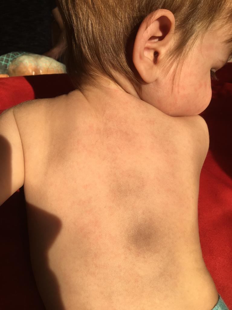 Aperçu de l'éruption cutanée causée par la roséole dans le dos de l'enfant 