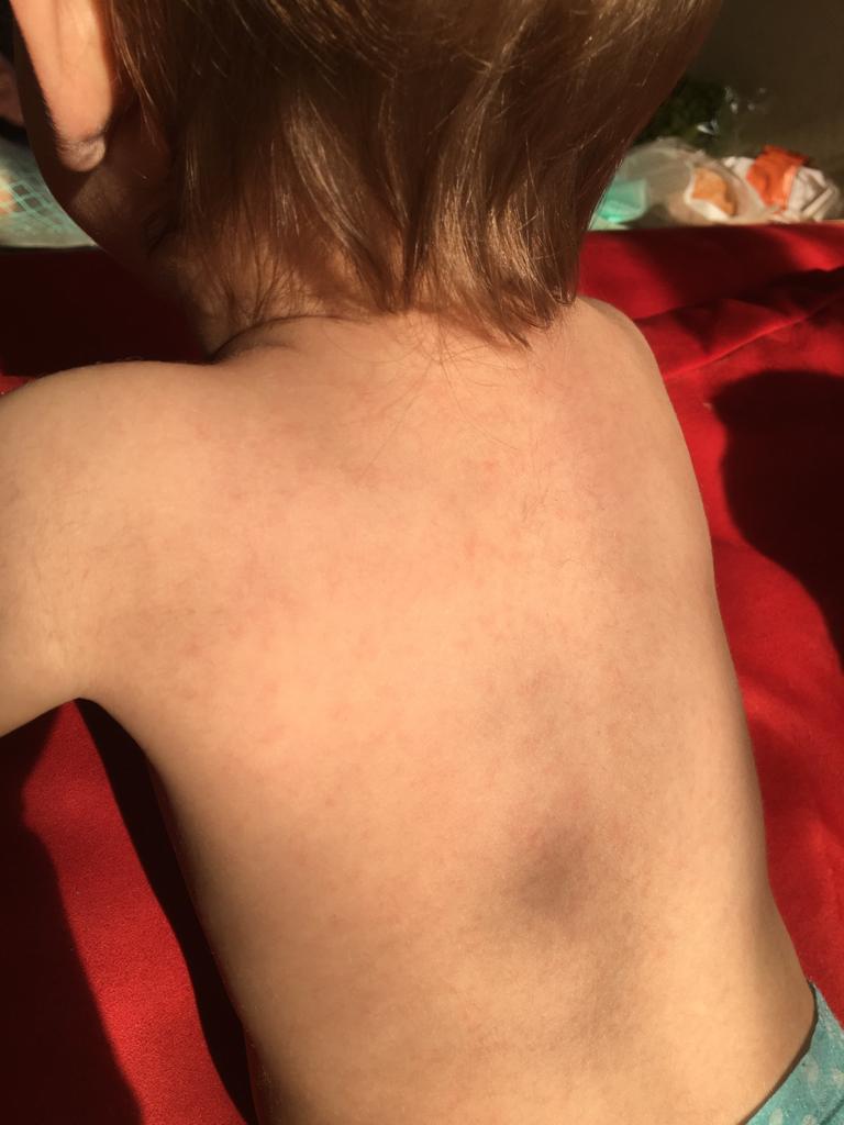 Aperçu de l'éruption cutanée causée par la roséole dans le dos de l'enfant et sur le visage